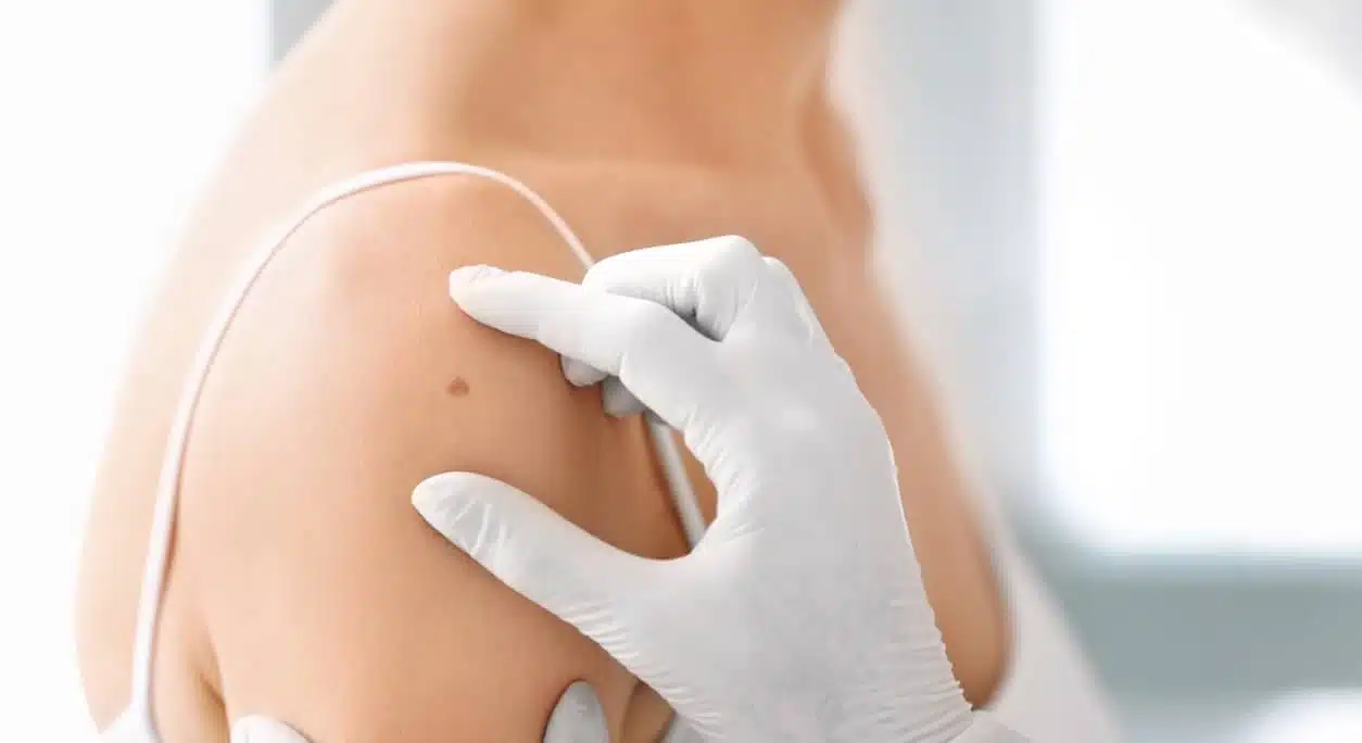 La chirurgie est-elle obligatoire pour retirer un carcinome basocellulaire ? | Dr Goldammer | Bordeaux