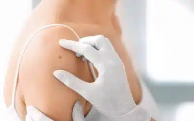 La chirurgie est-elle obligatoire pour retirer un carcinome basocellulaire ? | Dr Goldammer | Bordeaux