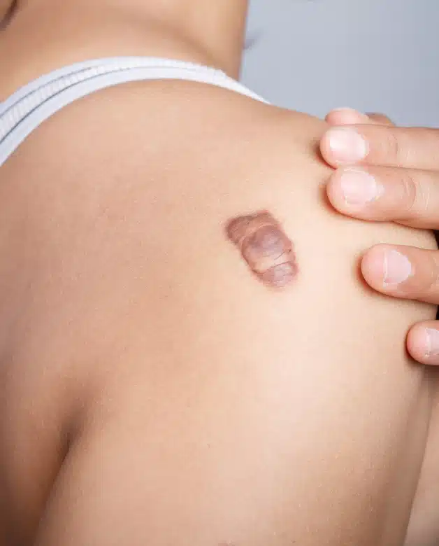 Cicatrices Chéloïdes | Chirurgie esthétique | Dr Goldammer